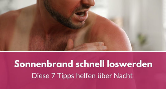 Mit diesen 7 Tipps wird man Sonnenbrand über Nacht los
